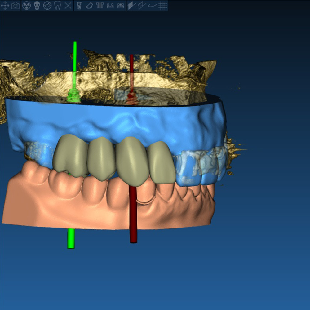 DVT2