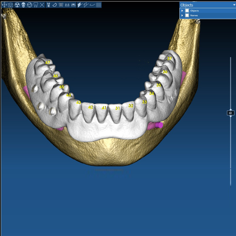 DVT5